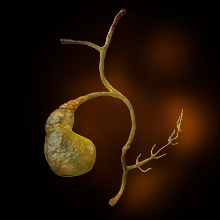 Cholecystectomy