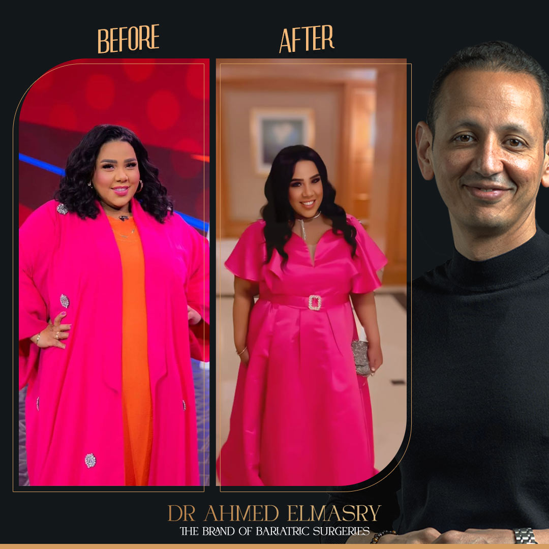 الفنانة شيماء سيف بعد ما خست ٥٠ كيلو من وزنها بعد عملية التكميم
